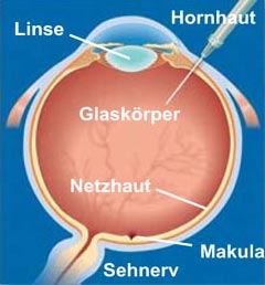 Grafik vom Berufsverband des Augenärzte BVA